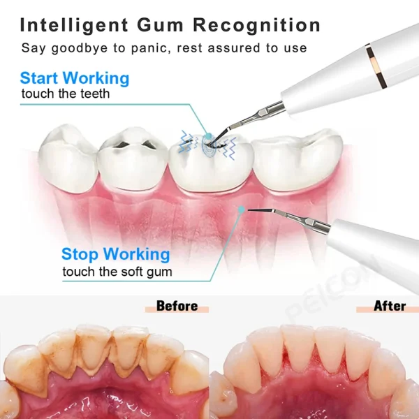 GlowSmile — Ultraljudsrengöring för ett Synligt Fräschare Leende